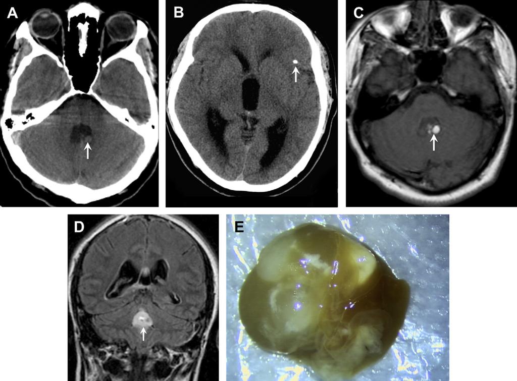 566 Aiken Fig. 10. Intraventricular neurocysticercosis. 30-year-old man with increasing headache.