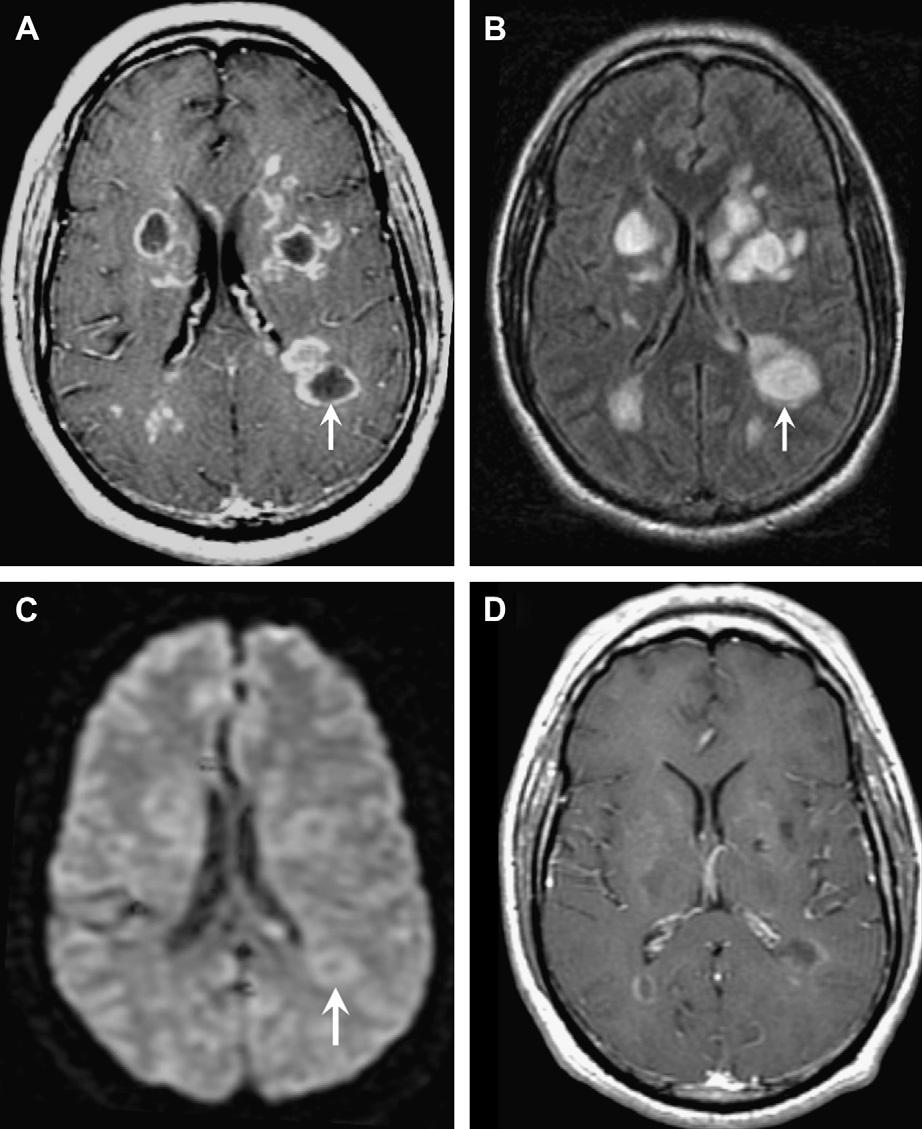 CNS Infection 569 Fig. 13. Acute disseminated encephalomyelitis (ADEM). 43-year-old man with acute altered mental status.