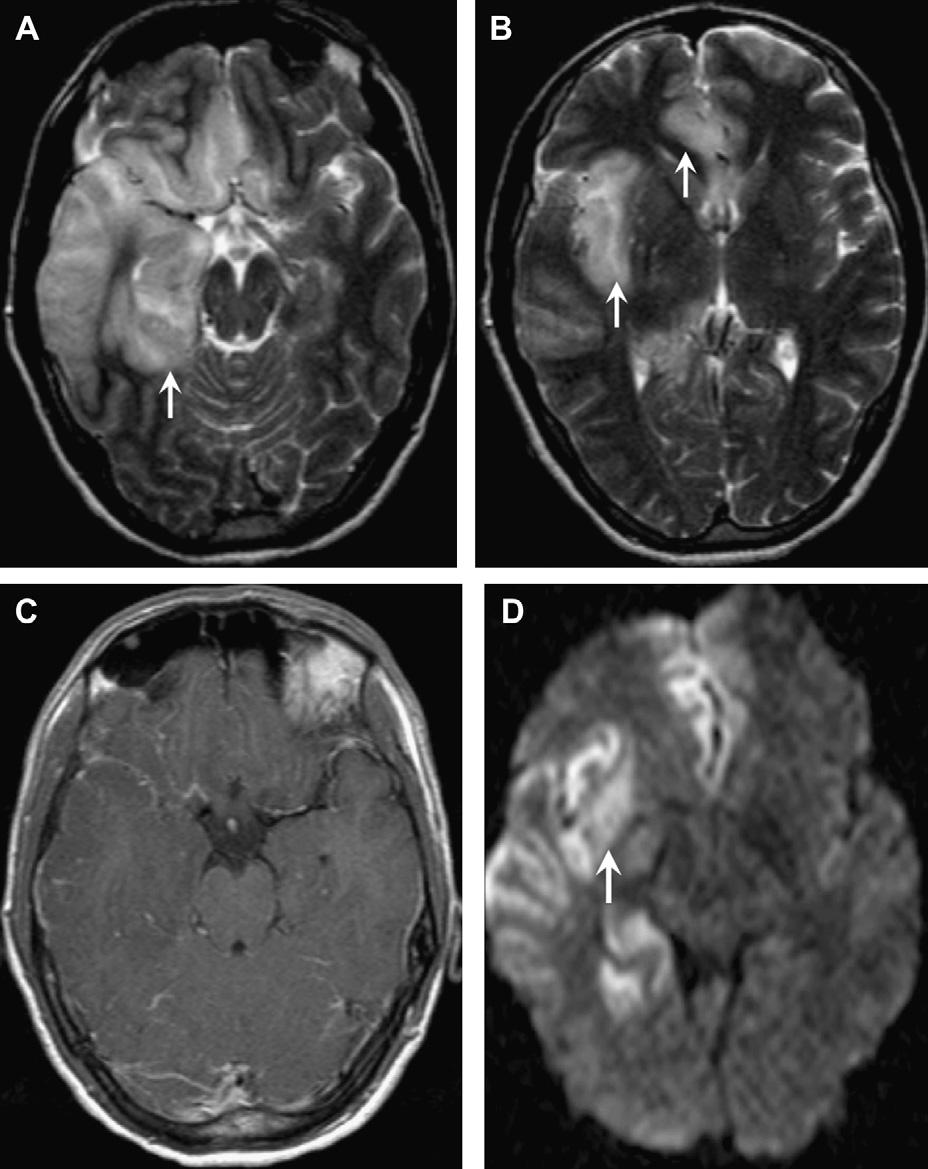 CNS Infection 571 Fig. 15. Herpes encephalitis (typical distribution). 44-year-old woman with mental status changes.