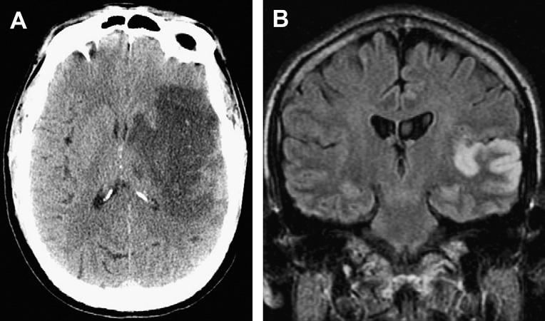 572 Aiken Fig. 16. Middle cerebral artery infarction (contrast with HSV). (A) Axial CT shows hypodensity involving the left basal ganglia and temporal lobe.