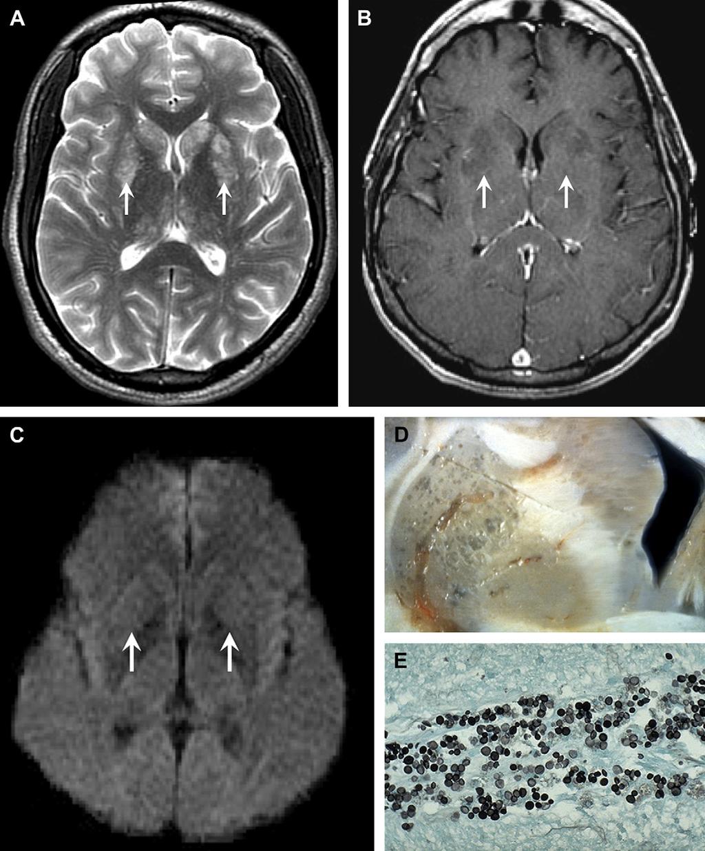 CNS Infection 573 Fig. 17. Cryptococcal gelatinous pseudocysts. 47-year-old HIV-positive man with headache.