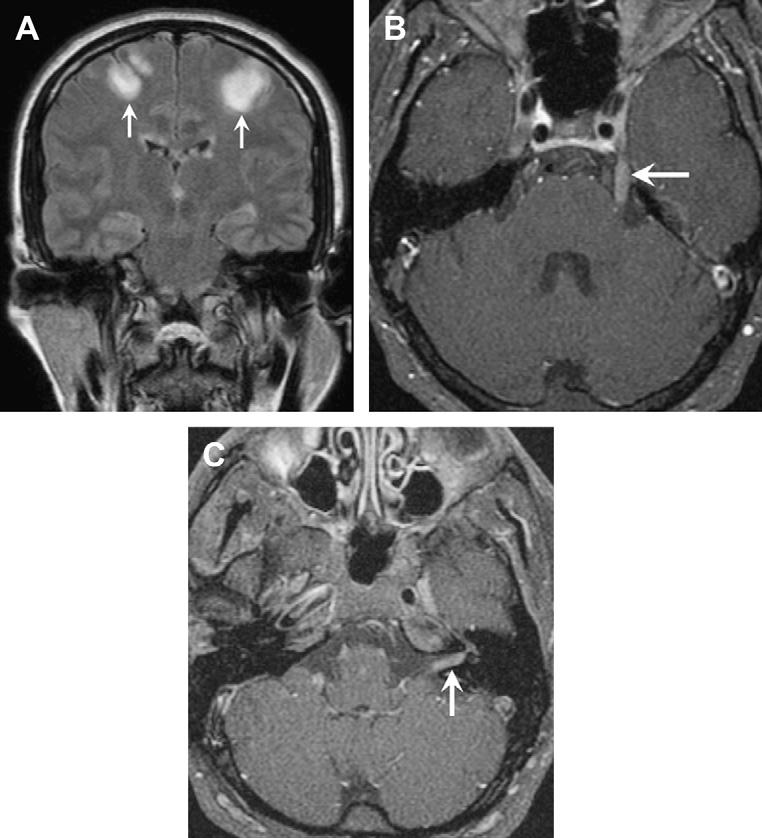 575 Fig. 19. Neuroborreliosis (Lyme disease). 19-year-old man with multiple cranial neuropathies.