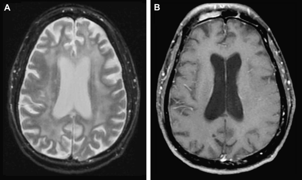 Lyme lesions can often mimic demyelinating disease. (B, C) Axial T1-weighted post-gad images demonstrate enhancement of the left fifth, seventh, and eighth nerves (arrows). Fig. 20.