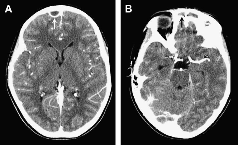 558 Aiken hyperintensity, this finding is not specific for leptomeningitis; it may also be encountered with leptomeningeal tumor, subarachnoid hemorrhage, supplemental O 2 administration, and severe