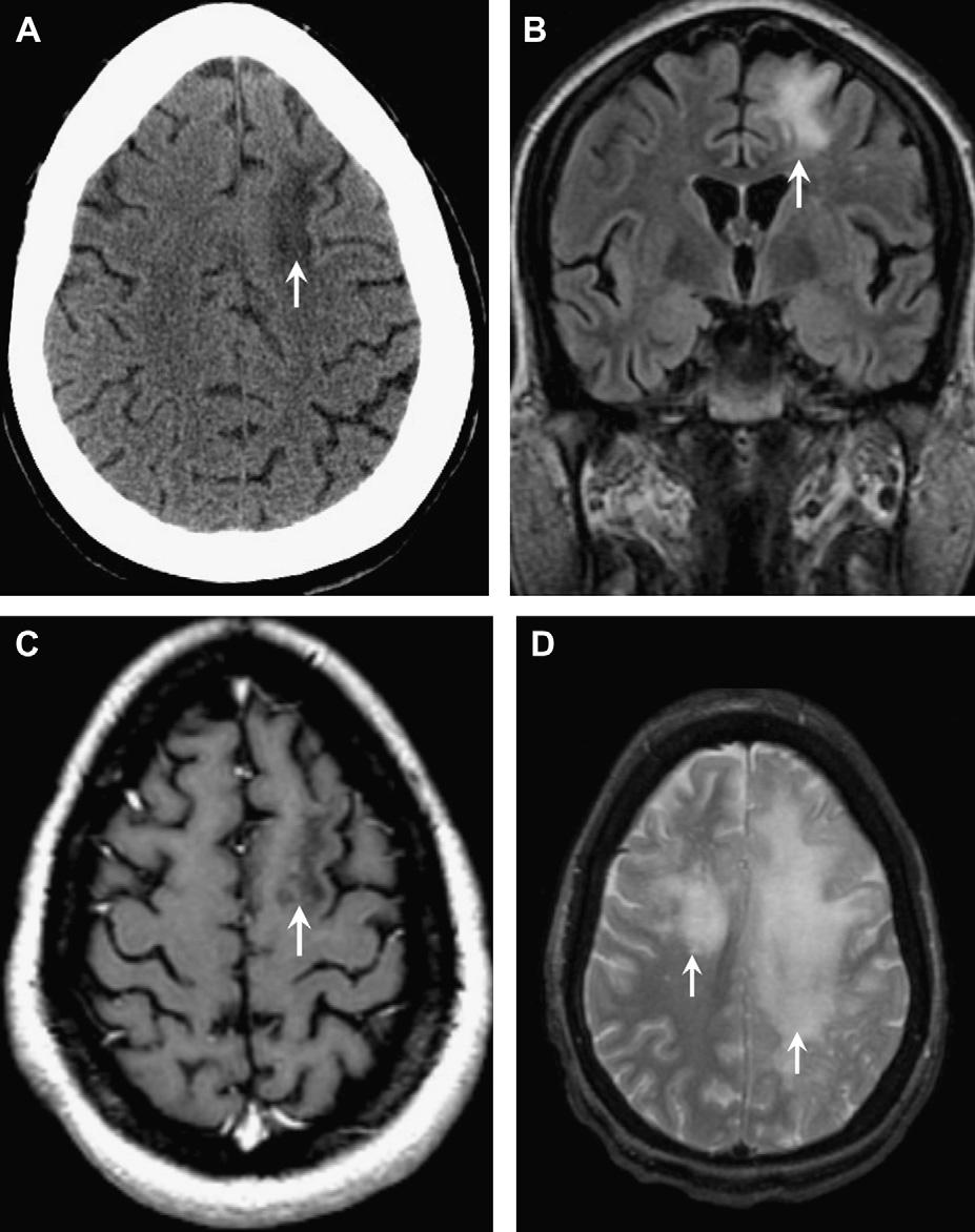 576 Aiken not seen in MS, and is therefore another clue to the correct diagnosis in the setting of nonspecific white matter lesions (see Fig. 19B, C).