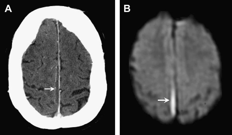 CNS Infection 559 Key Imaging Features: Epidural Empyema Lentiform collection Reduced diffusion Look for source in paranasal sinuses or mastoid air cells.