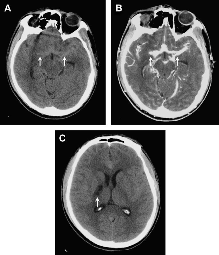 560 Aiken Fig. 3. Coccidiomycosis and basilar meningitis. 23-year-old migrant worker with headache and left upper extremity weakness.