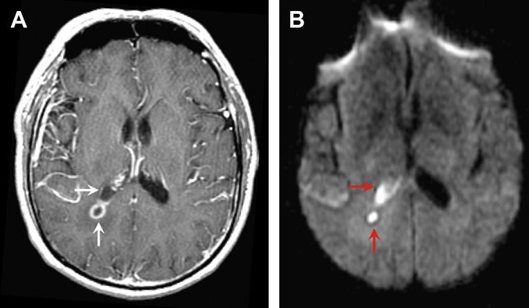 562 Aiken Fig. 5. Brainstem pyogenic abscess mimicking glioblastoma multiforme (GBM). 53-year-old man presented for preoperative evaluation for presumed GBM, without signs and symptoms of infection.