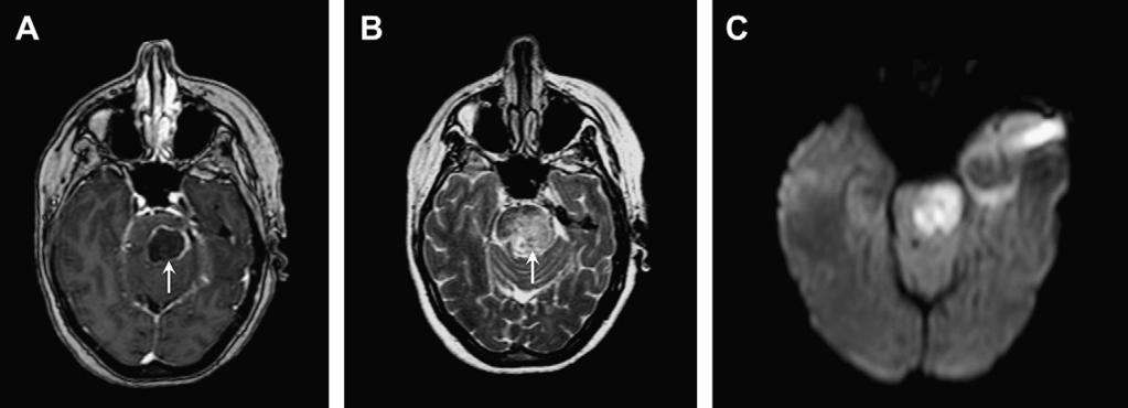 (B) Axial T2-weighted image reveals ill-defined T2 hyperintensity (arrow) rather than the more typical discrete T2 hyperintensity; this finding suggests an earlier stage of infection.