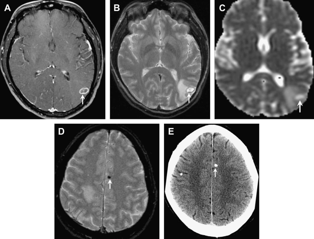 CNS Infection 565 Fig. 9. Colloidal stage and nodular calcified stage of neurocysticercosis. 39-year-old man with new seizure.