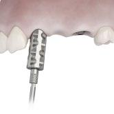 The design of each impression component takes into consideration the following aspects: Open- or closed-tray impression technique Occlusal space and adjacent teeth relation Uni Abutment EV Pick-Up