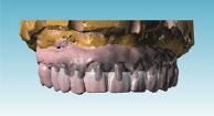 Note: implant suprastructures are manufactured only after review and final approval of the design, in Atlantis suprastructures Viewer.