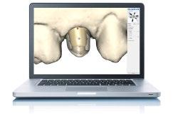 Consult the Design guide Atlantis patientspecific abutments and crowns