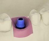 CastDesign abutment is first reduced and shaped in wax before the cast-to procedure.