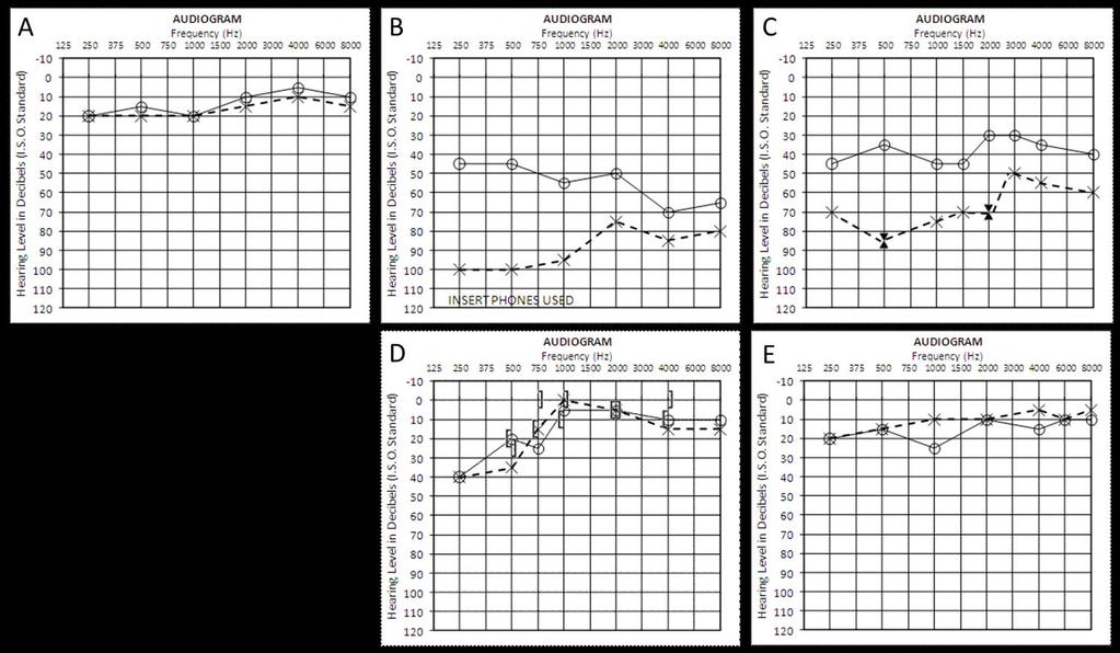 RFVT2 Riboflavin Therapy Figure 5.1: Audiometry in BVVL patients before and after riboflavin therapy Audiometry in patient 1.