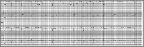 infarction Brother at 35 years old Sudden onset chest pain, nausea and emesis EKG