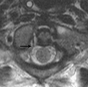 VERTEBRAL COLUMN INJURY (SPECIFIC INJURIES) TrS9 (10) Flexion and extension dynamic CT - craniovertebral junction instability (atlanto-dens interval > 3 mm) caused by traumatic