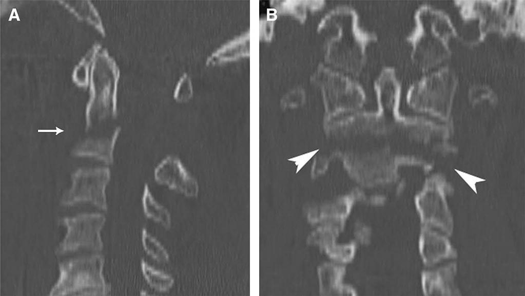 2006;58(4):797 798 OS ODONTOIDEUM Definition - ossicle with smooth circumferential cortical margins representing odontoid process that has no osseous continuity with body of C2.