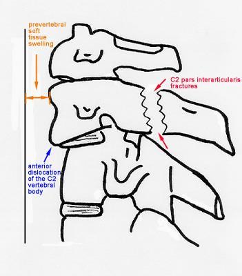 VERTEBRAL COLUMN INJURY (SPECIFIC INJURIES) TrS9 (12) CLASSIFICATION AND Effendi classification: Type I (stable): isolated hairline fracture of axis ring with minimal displacement of C2 body