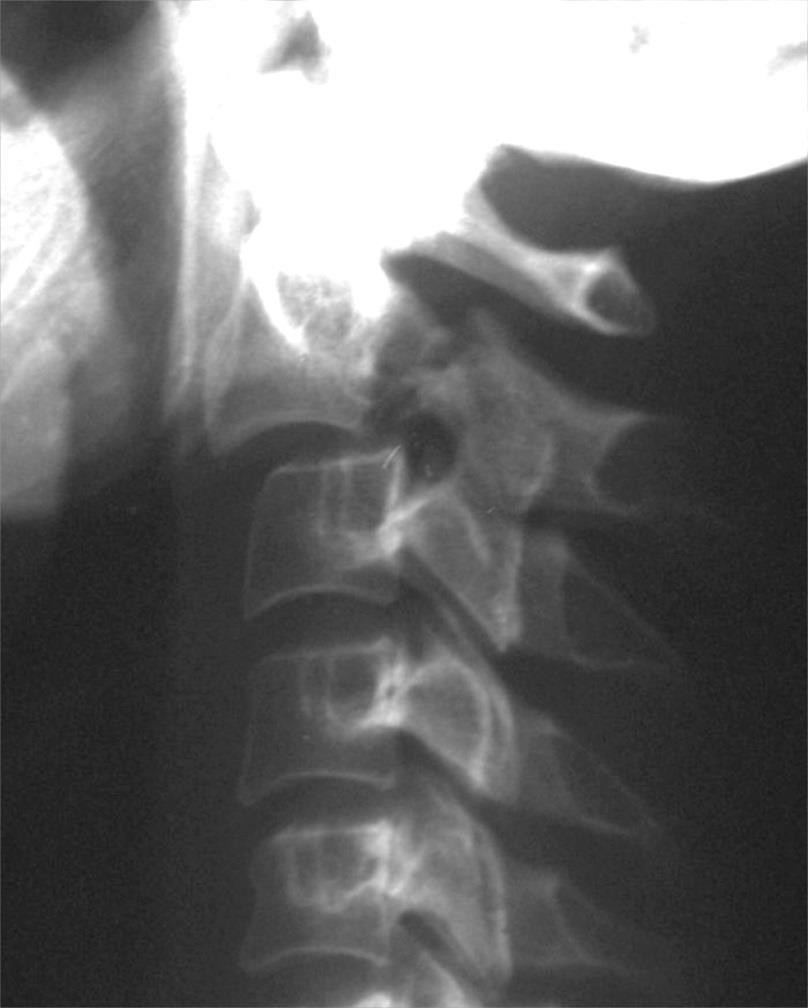 VERTEBRAL COLUMN INJURY (SPECIFIC INJURIES) TrS9 (13) Resume - indications for surgery: a) severe angulation (Francis grade II and IV, Effendi type II) b) severe (> 5 mm) translation c) C2-3 disc