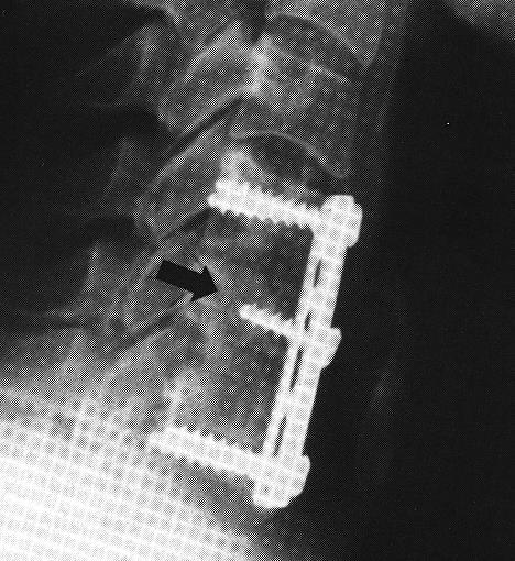 b) bone / disk impingement on spinal canal decompression via anterior approach (corpectomy); Flexion compression fracture of C 5 fixed by corpectomy and fusion maintained with Caspar plate: c) injury