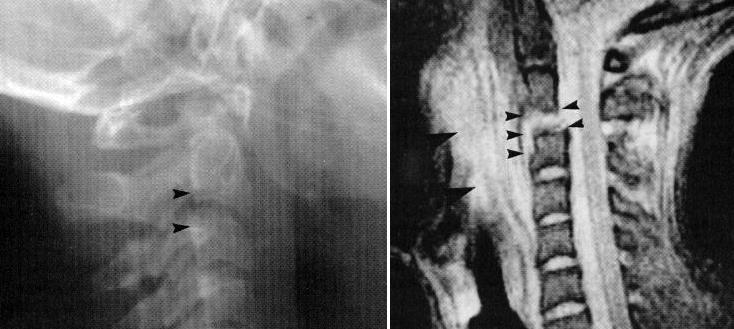 VERTEBRAL COLUMN INJURY (SPECIFIC INJURIES) TrS9 (16) ANTERIOR SUBLUXATION (stable in extension but potentially unstable in flexion) - posterior ligamentous rupture without bony fracture.