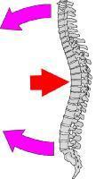 VERTEBRAL COLUMN INJURY (SPECIFIC INJURIES) TrS9 (24) N.B. include at least 2 levels above and 2 levels below fracture; short segment fusions (1 above, 1 below) are rarely acceptable!