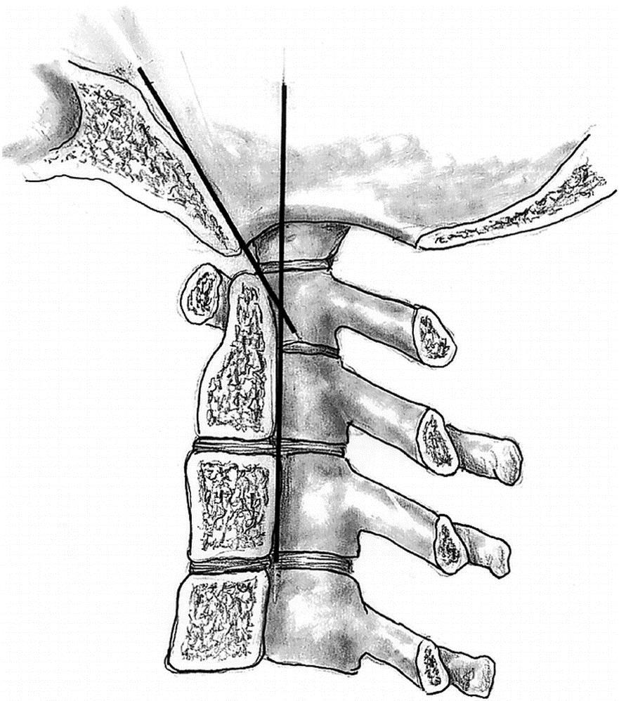 VERTEBRAL COLUMN INJURY (SPECIFIC INJURIES) TrS9 (4) this relationship does not change in flexion and extension if this line runs behind odontoid, posterior subluxation has occurred and vice versa; D.
