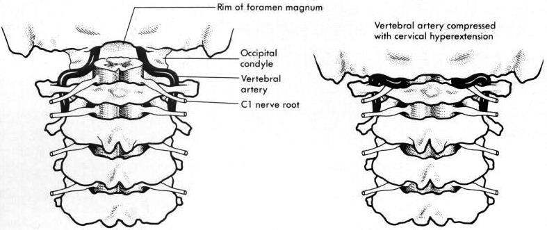 see below >> a) transverse ligament intact (stable) b) transverse ligament disrupted (unstable) Landell type 3 (stable) fracture through lateral mass of C1.