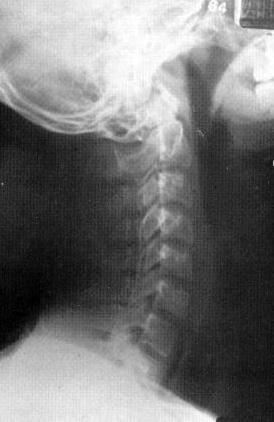 removed and bony struts are affixed to remaining occipital bone and decorticated C2 laminae; bony struts are supported by wires or metallic plates) halo. LATERAL MASS FRACTURE (C1) A.