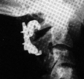 VERTEBRAL COLUMN INJURY (SPECIFIC INJURIES) TrS9 (9) treated with cervical collar (successful in 100% cases). may be associated with life-threatening atlanto-occipital dislocation (H: fusion).