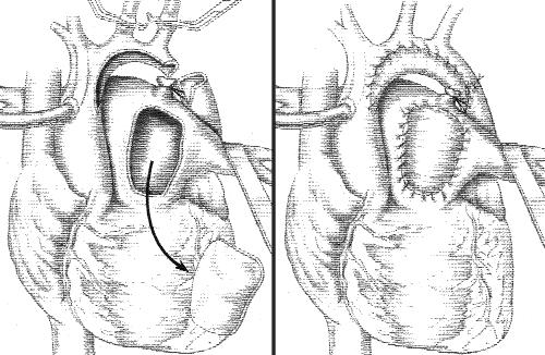 EDITORIAL CHD CHD ACD ET CSP TX Figure 1. Drawing representing aortic repair technique by means of pulmonary autograft patch augmentation. TABLE 1.