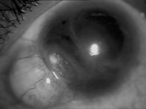 Scleral patch graft for cases of scleral defects 933
