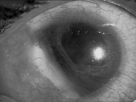 staphyloma with uveal exposure and corneal oedema.