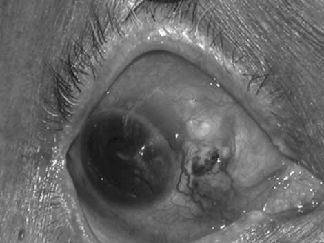 Figure 2 (Patient 3) One week postoperative photograph