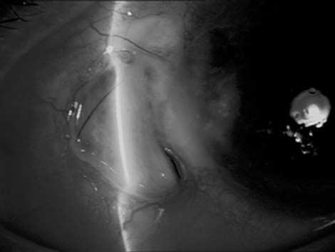 Figure 5 (Patient 6) Scleral melt with uveal exposure 7