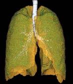 Radiographic Interstitial Lung Abnormalities in Smokers 1 2 3 4 A B C