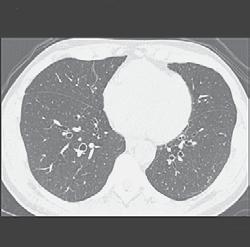 interstitial lung abnormalities; Panel B, subpleural interstitial