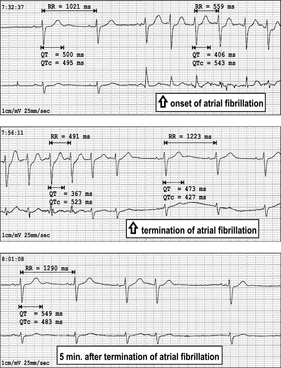 Changes in heart rate due to conversion of AF 117 Figure 2 Example of a Holter ECG recording documenting the beginning and termination of atrial fibrillation.