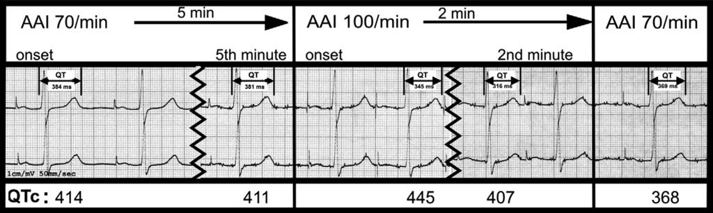 Changes in heart rate due to conversion of AF 119 Figure 5 Printout of the ECG during the stimulation protocol.