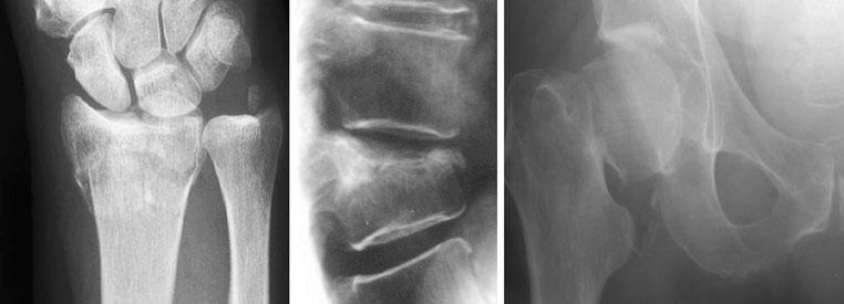 80-85- 90-95+ Age (years) Fig. 3 Typical osteoporotic fractures at the distal forearm (left), spine (centre) and hip (right) 1.3.1 Hip fracture Hip fracture is the most serious osteoporotic fracture.