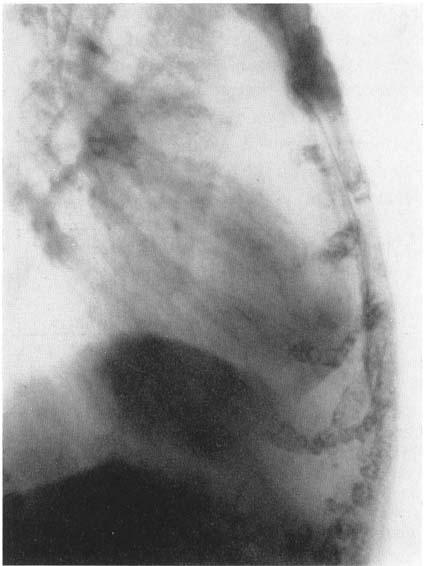 236 D. W. SMITHERS AND P. RIGBY-JONES Fig. 1. Sclerosis in sternum following radium implant to parasternal node recurrence. 24 years previously.