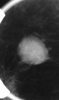 A dense, ovoid and well-defined mass is observed, 2cm in major diameter, located in the superoexternal sector of right by non imaging methods was suggested.