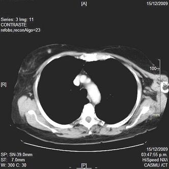 pelvic CT which did not show other metastases. By the end of 2009, another thoraxabdominal-pelvic CT is requested, as part of the oncologic control.