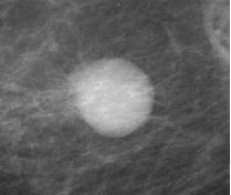 metastasis have been reported. Although not frequent, this finding may be the first manifestation of the disease (2). carcinoma, which makes them very rare. A B C Figure 3. Mammography year 2009.