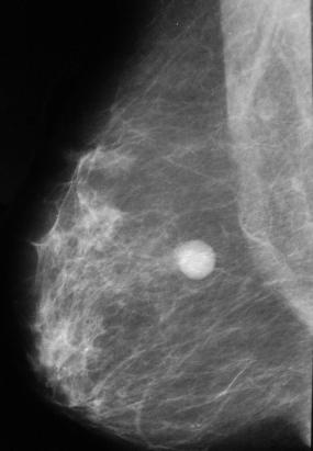 A new nodule is observed, of similar characteristics to the one previously removed, located in the central sector of the right breast.