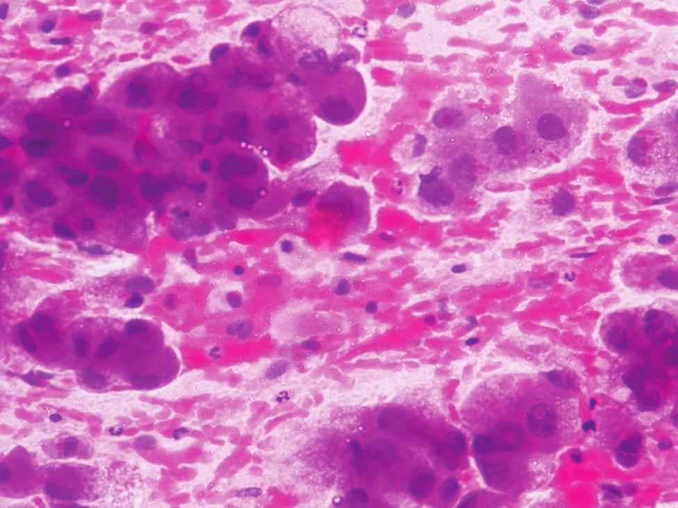 (H and E, 10) Figure 2: Hepatocellular carcinoma - showing trabecular pattern of cells,