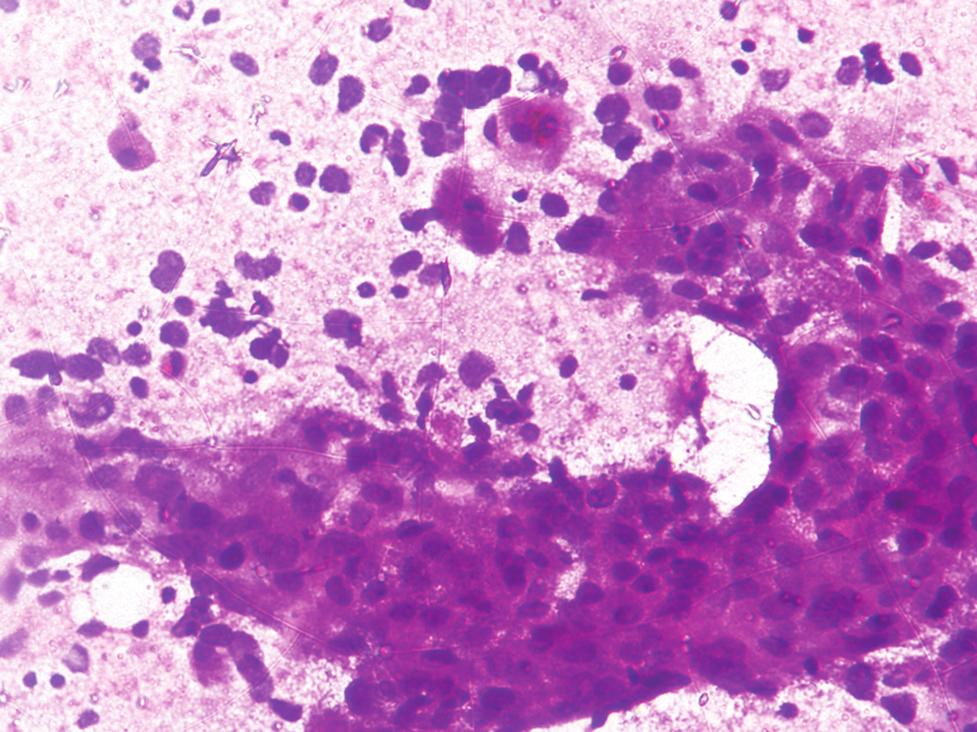 Hepatocellular carcinoma - smear shows sinusoidal pattern, clusters are traversed by
