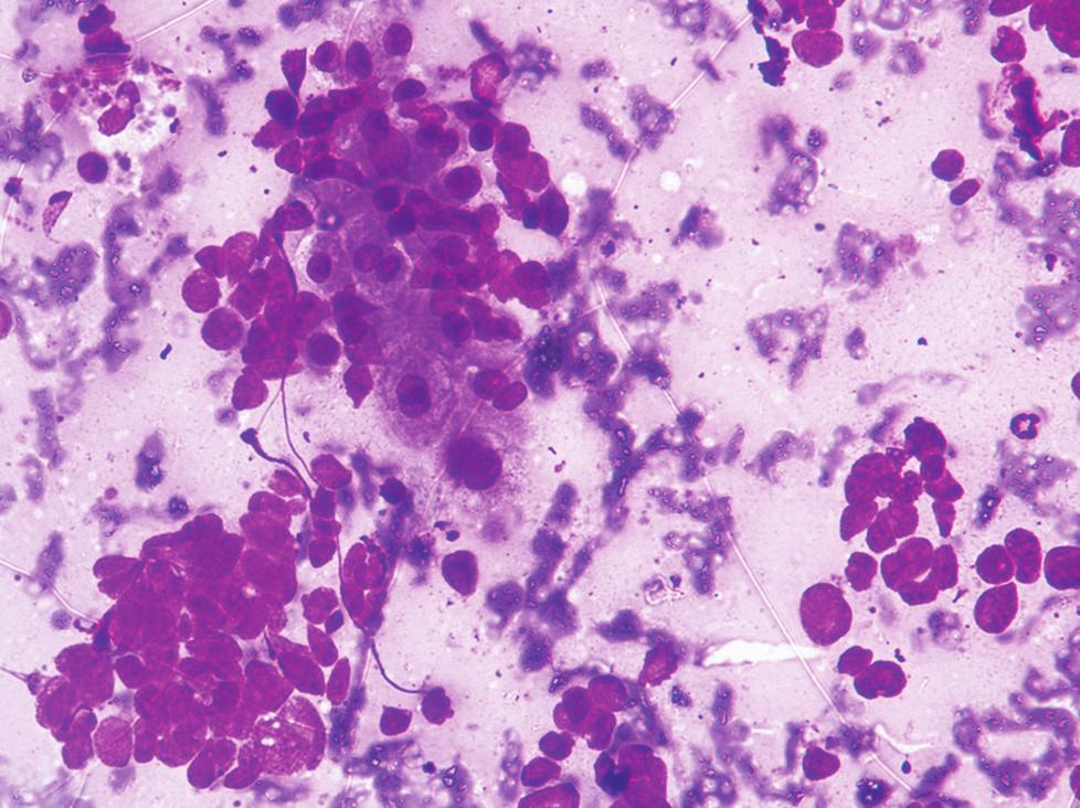 carcinoma - showing cluster of cells, having moderate amount of cytoplasm, round nuclei