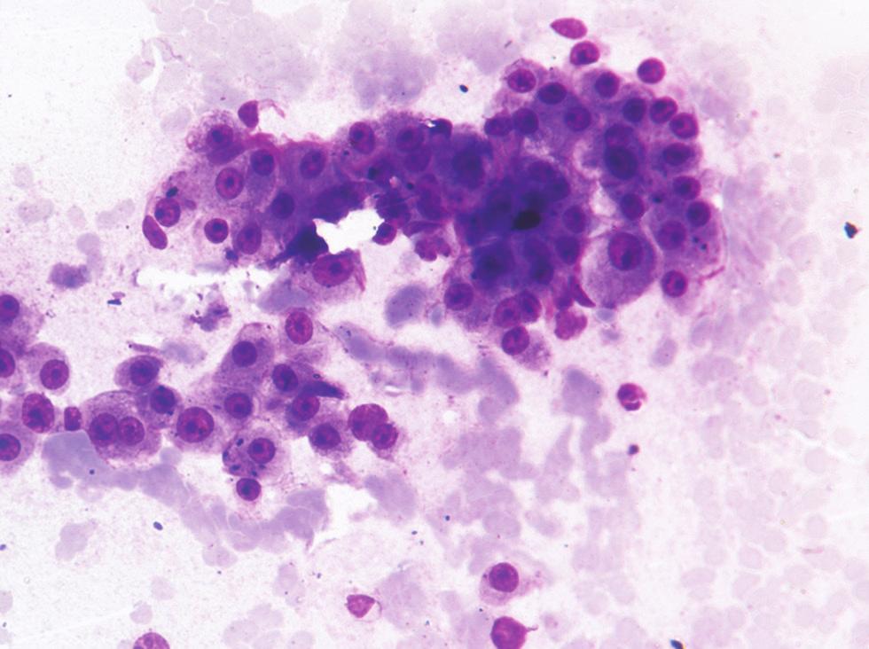 carcinoma - smear showing cells arranged in clusters and dispersed pattern having